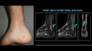 Achilles tendon rupture in a HD patient