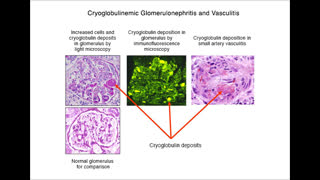 CRYOGLOBULINS AND RENAL DISEASE 