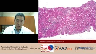 Web Episode #010 - Renal Pathology Teaching Series, Introducing Lupus Nephritis