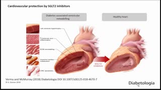 SGLT2 Inhibitors in Type 2 DM: A Cardiorenal "Game-Changer"