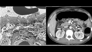 48-year-old man presents with acute onset right flank pain and nephrotic syndrome