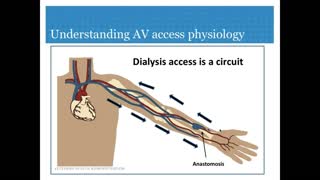 Dialysis AV Access and cardiac function