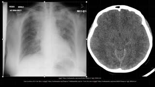 55-year-old lady with ASA poisoning, dyspnea and altered mental status.