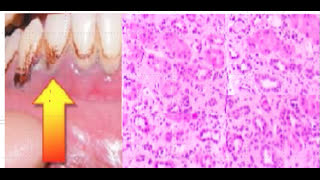 55-year-old male with post renal transplant with worsening renal function, HTN and gout attacks.